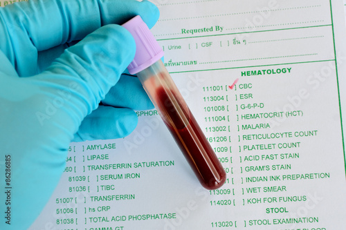 Photos Blood sample for CBC (complete blood count) testing