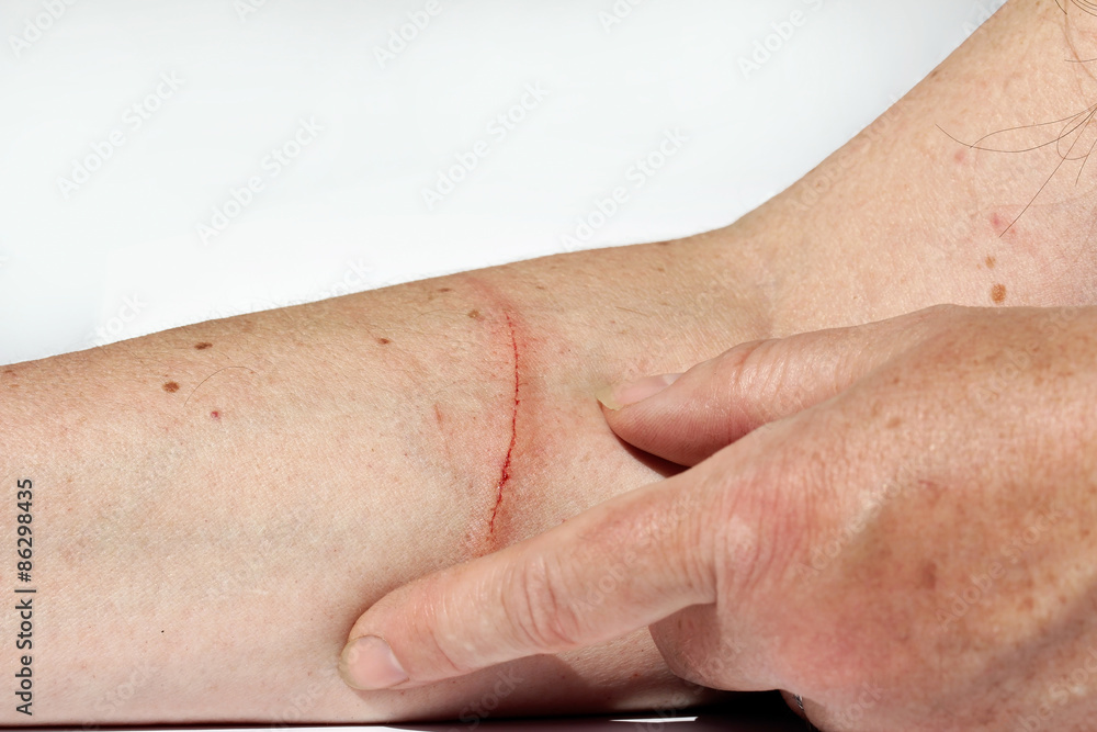 Fototapeta premium Eine blutende Verletzung am Arm einer Frau