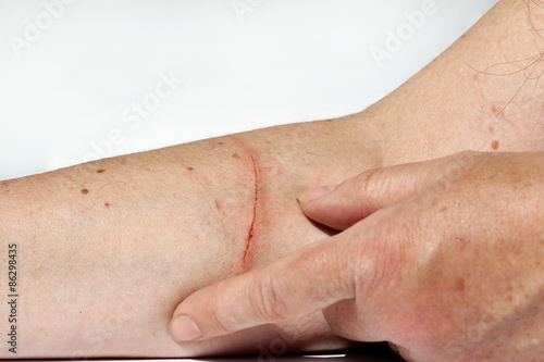 Eine blutende Verletzung am Arm einer Frau