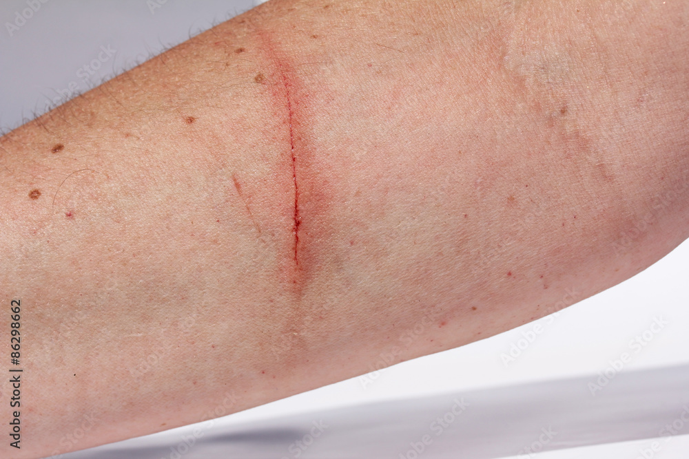 Ein blutender Kratzer am Arm einer Frau Ein blutender Kratzer am Arm einer Frau