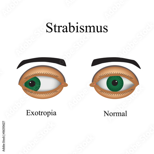 Diseases of the eye - strabismus. A variation of strabismus -