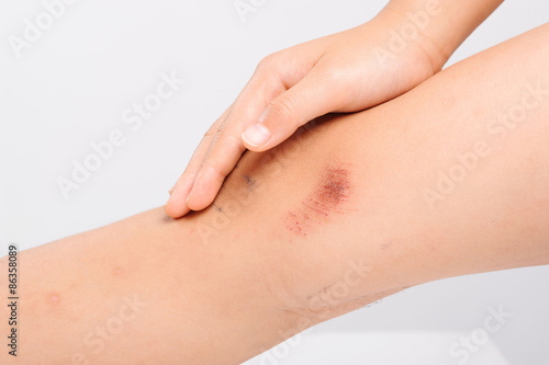 Wound on child knee from accident become dry