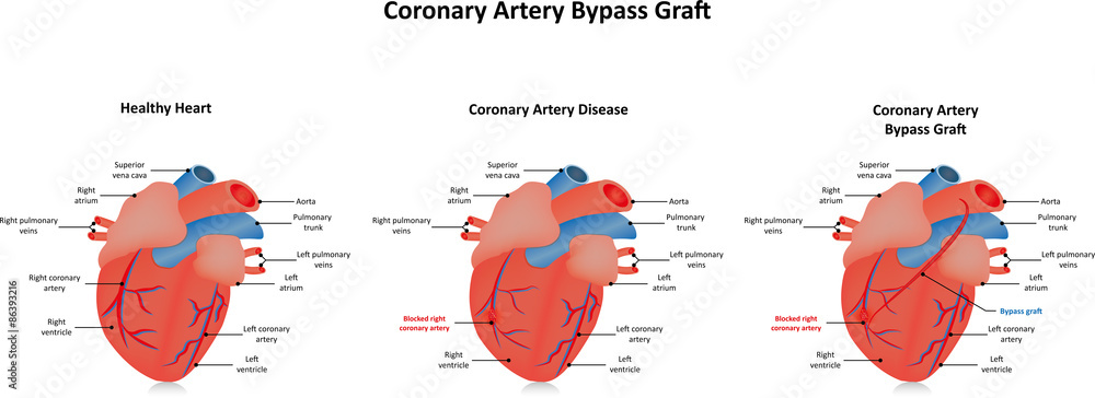 Coronary Artery Bypass Graft Stock Illustration Adobe Stock