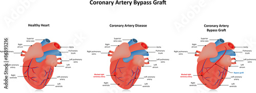 Obraz na płótnie Coronary Artery Bypass Graft
