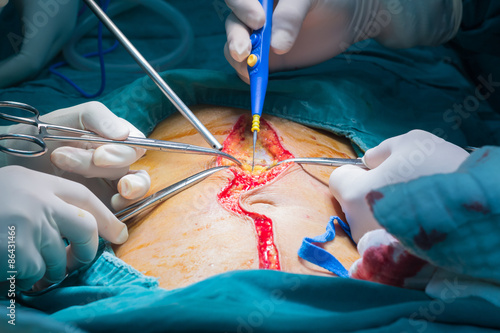 Abdominal surgery