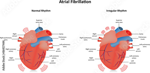 Atrial Fibrillation