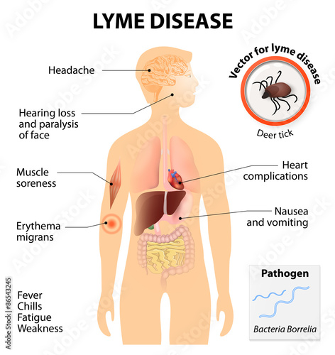 Lyme disease or Lyme borreliosis photo