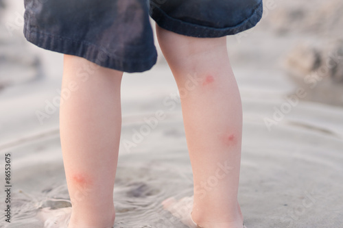 red itchy  bites on toddler boy's legs © zoeytoja