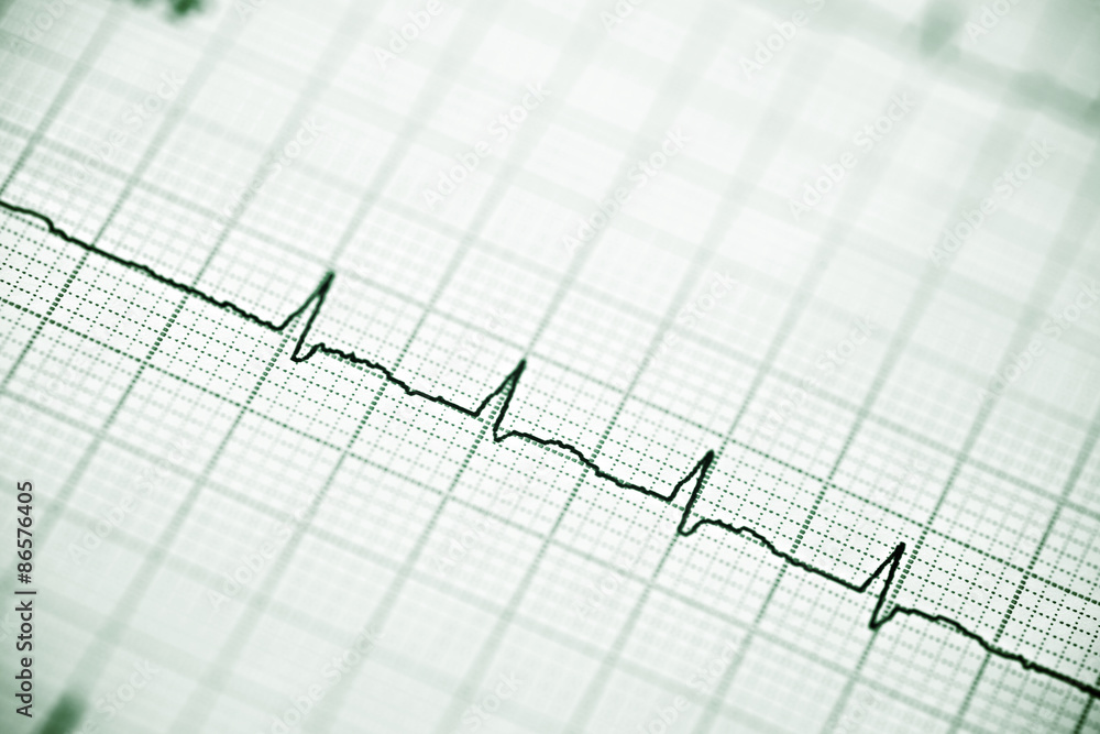 Electrocardiogram