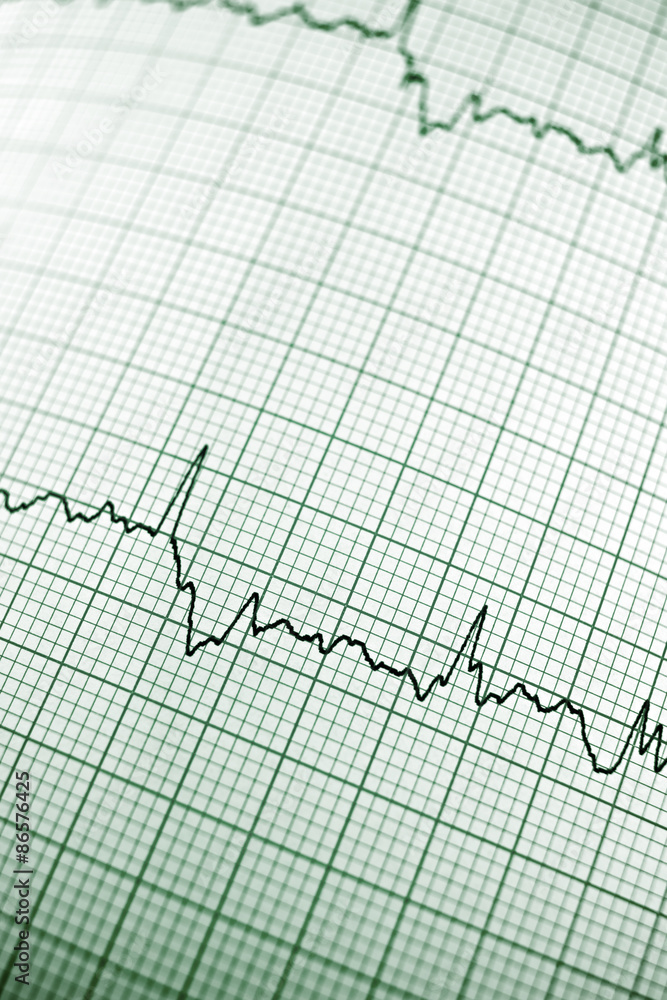 Electrocardiogram Electrocardiogram