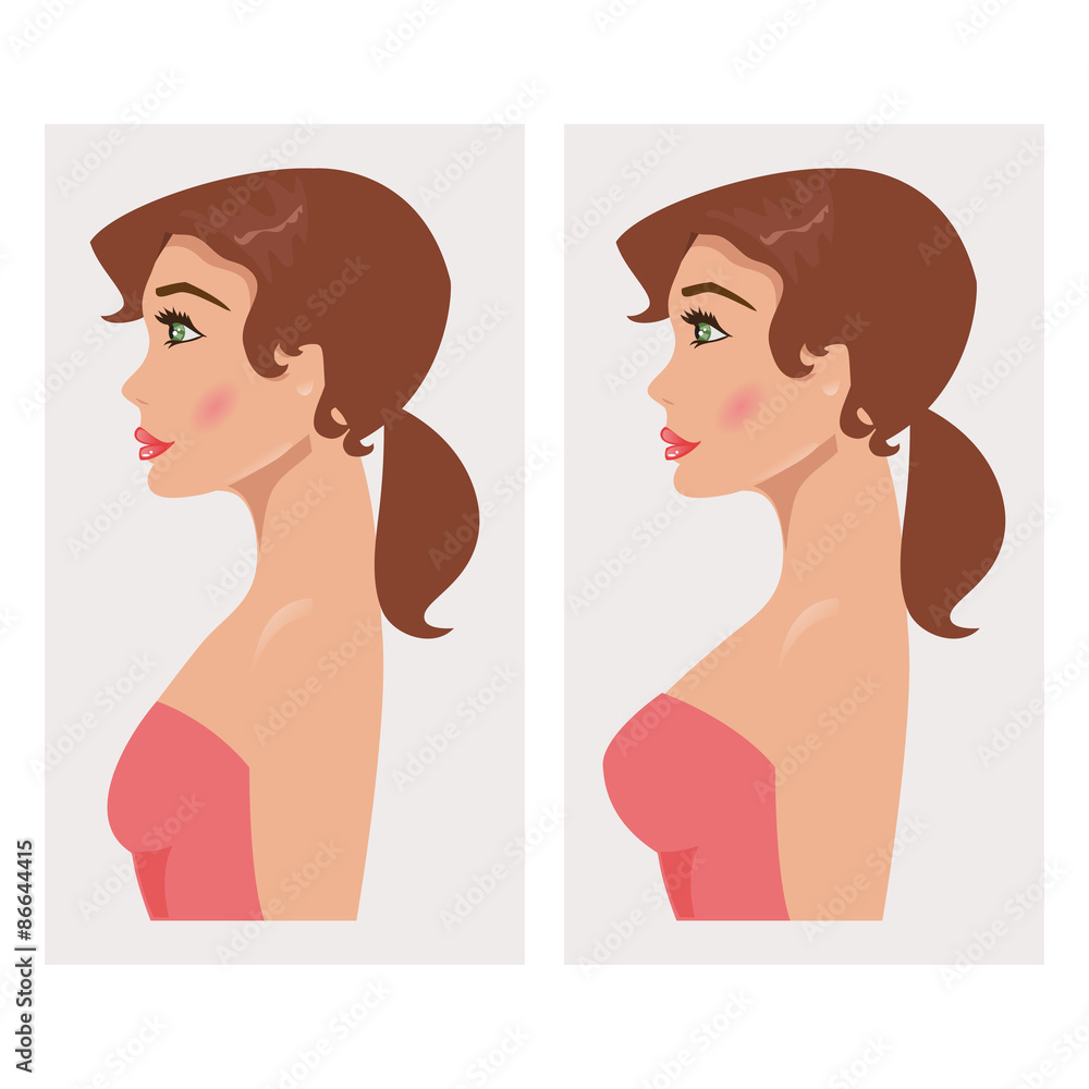 Chest before and after plastic. Vector Illustration Chest before and after plastic. Vector Illustration