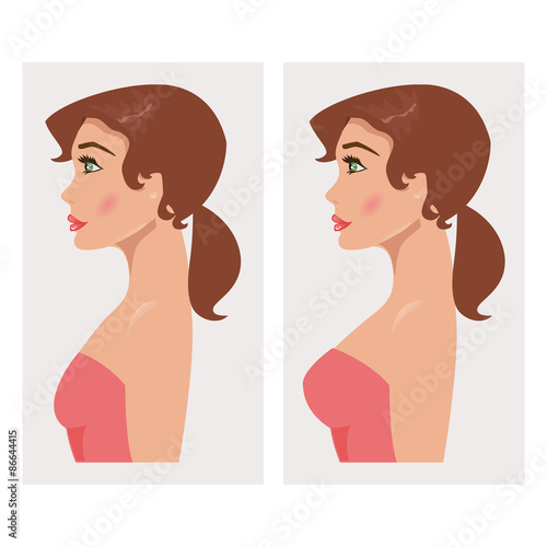 Chest before and after plastic. Vector Illustration