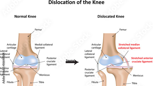 Dislocation of the Knee