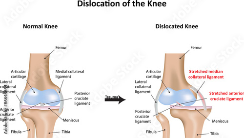 Tableau sur toile Dislocation of the Knee