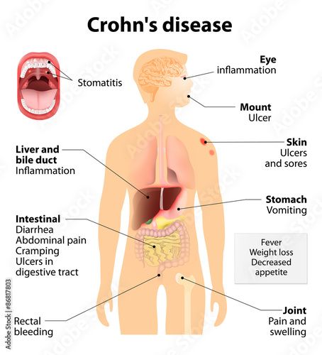 Crohn's disease or Crohn syndrome photo