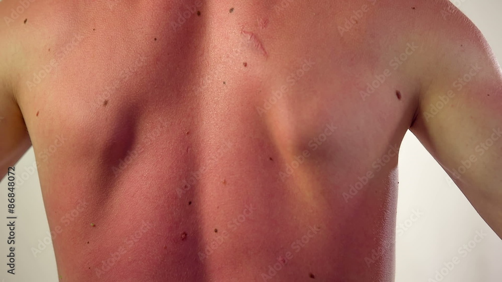 Sun-burnt man back white skin Sun-burnt man back white skin