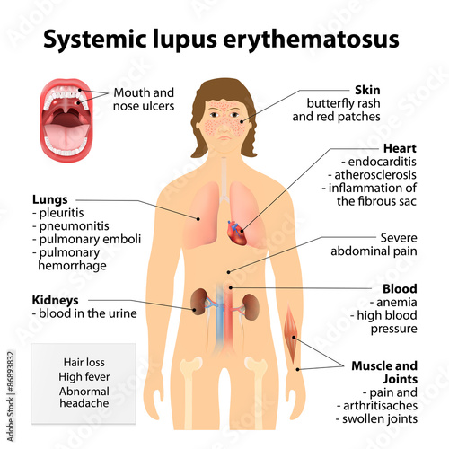 Systemic lupus erythematosu