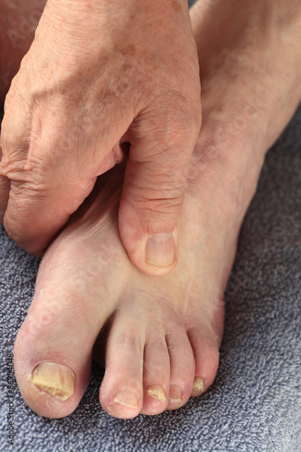 Toenail fungus on senior man
