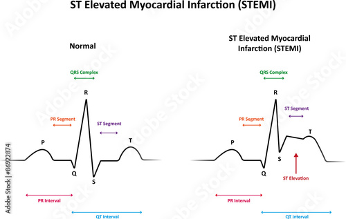 ST Elevated Myocardial Infarction