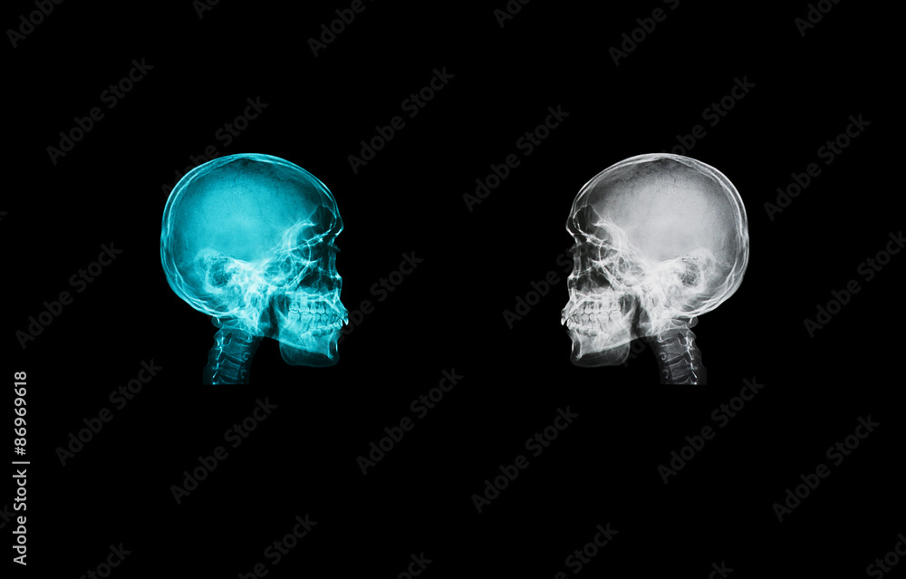 skull x-ray image isolate on black backgroud with clipping path skull x-ray image isolate on black backgroud with clipping path