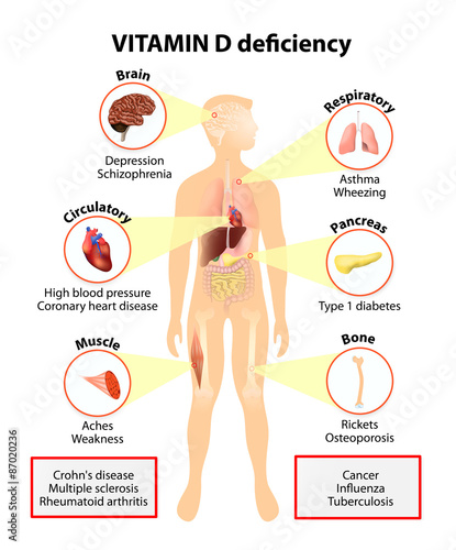 Vitamin D deficiency. symptoms and diseases