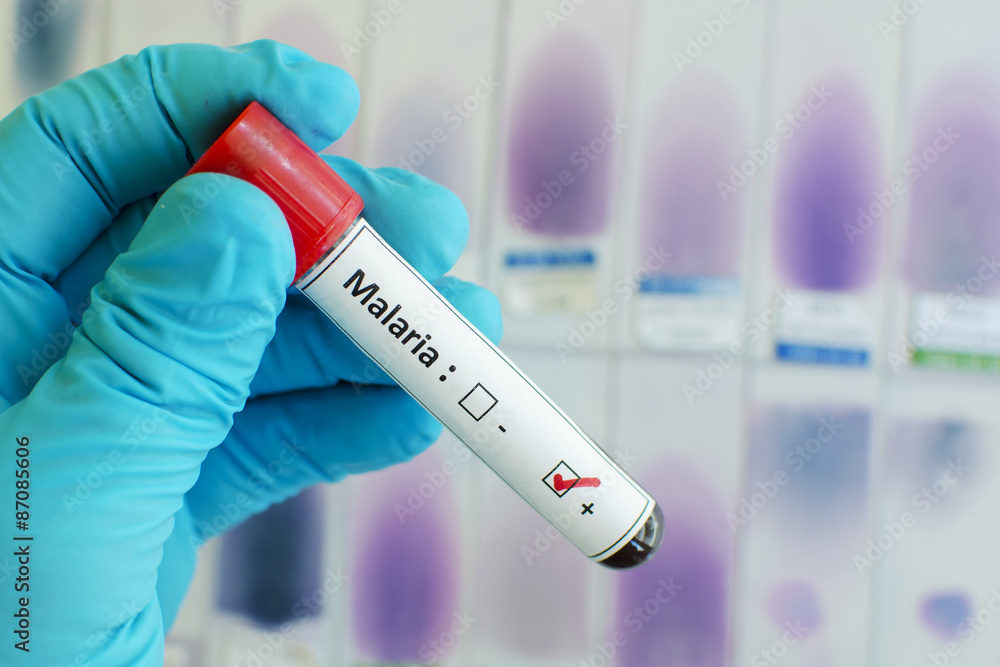 Fototapeta premium Malaria parasite positive