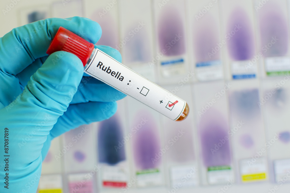 Fototapeta premium Rubella virus positive