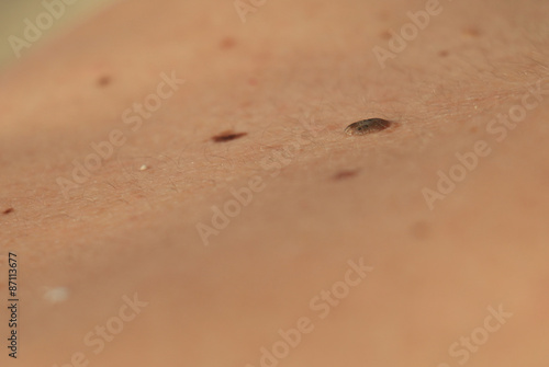 mole on the skin