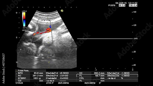 high quality ultrasound echography check. Gynecological medical examination. 33 weeks old pregnancy with fetus heartbeat recording and thermal analysis, high definition 1080p