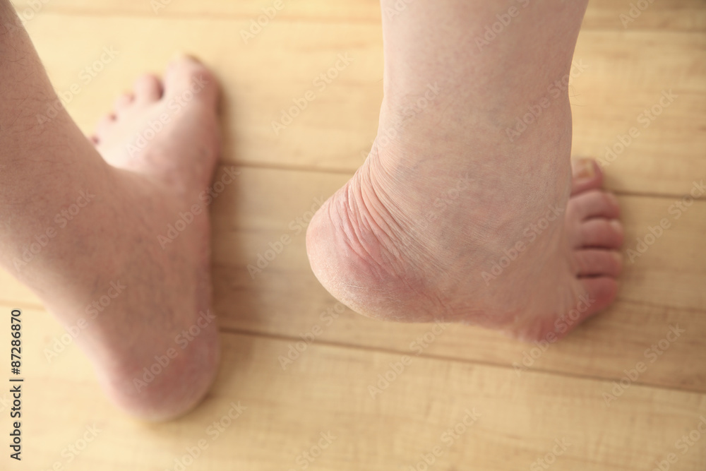 An older man rises on tip toes to show his heel. An older man rises on tip toes to show his heel.