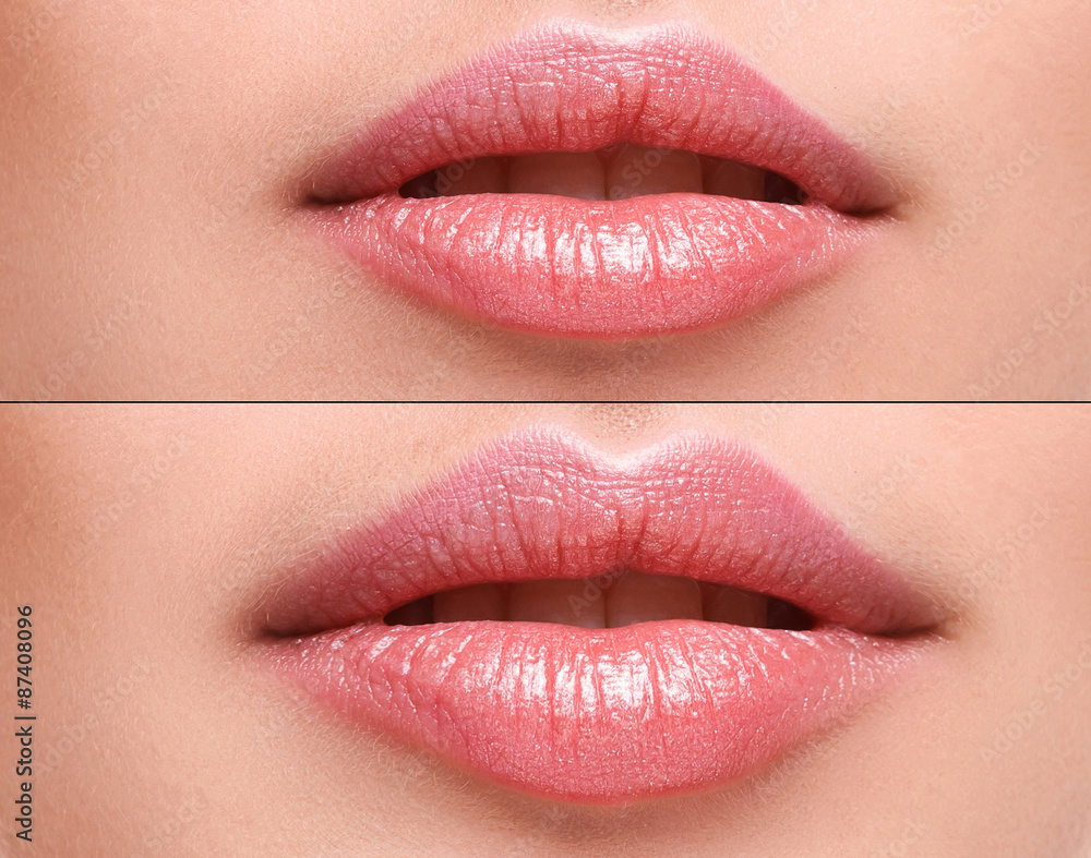 Fototapeta premium Lips before and after augmentation