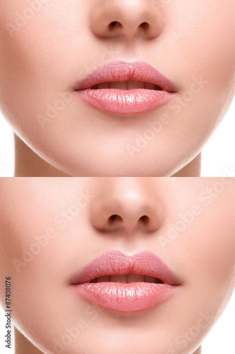 Fototapeta Lips before and after augmentation