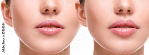 Obraz na płótnie Lips before and after augmentation