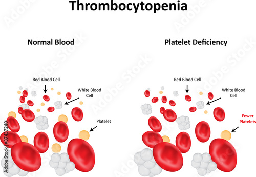 Thrombocytopenia photo