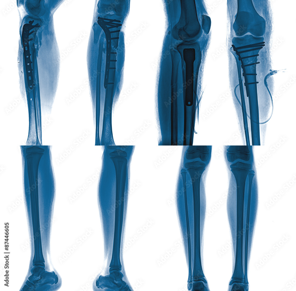 collection of x-ray of leg with metal plates , normal leg collection of x-ray of leg with metal plates , normal leg