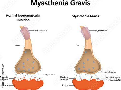 Myasthenia Gravis