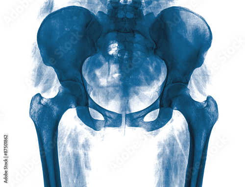 Foto X-ray of the pelvis and spinal column of a woman