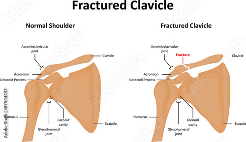 Fractured Clavicle Bone