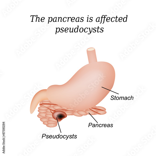 Pancreas pseudocyst affected. Vector illustration on isolated photo