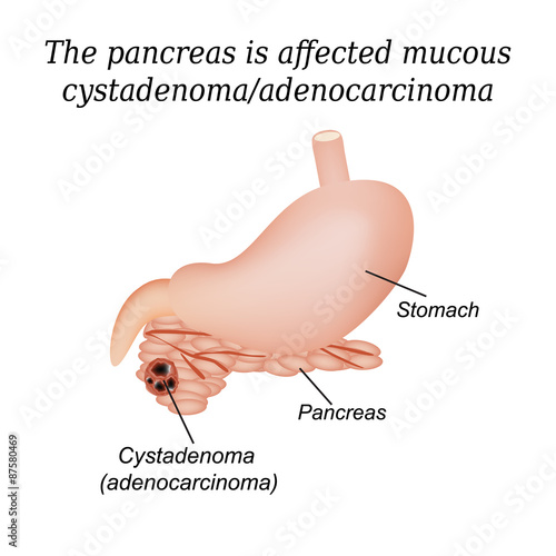 Pancreas mucous cystadenoma, adenocarcinoma. Vector illustration photo