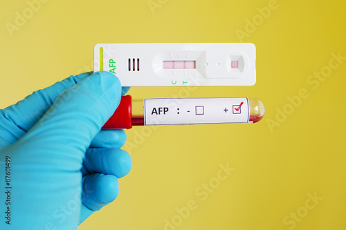 AFP (tumor marker for liver) positive photo