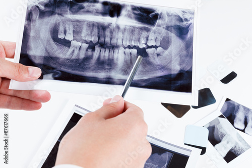 Panoramic dental x-ray image of teeth.