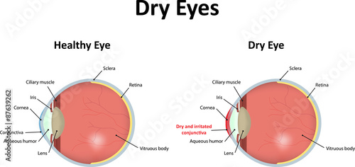 Dry Eyes Illustration