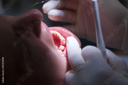 Patient at dental hygienists office