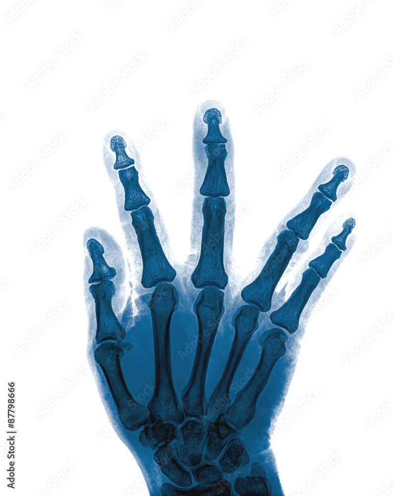 X-ray of hand fractures