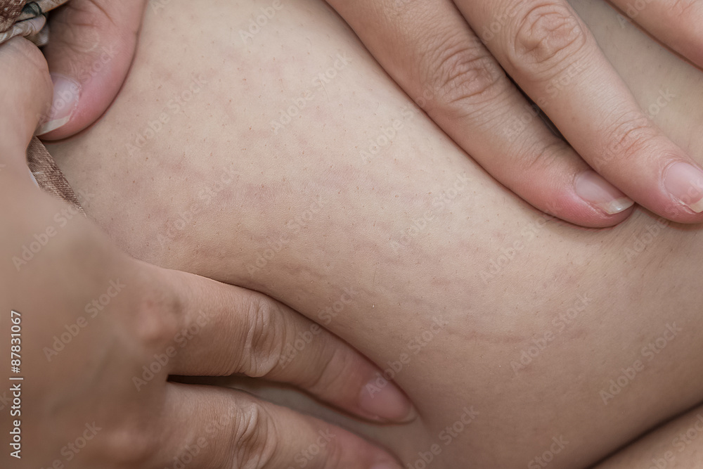 Close up stretch marks on Asian woman belly Close up stretch marks on Asian woman belly