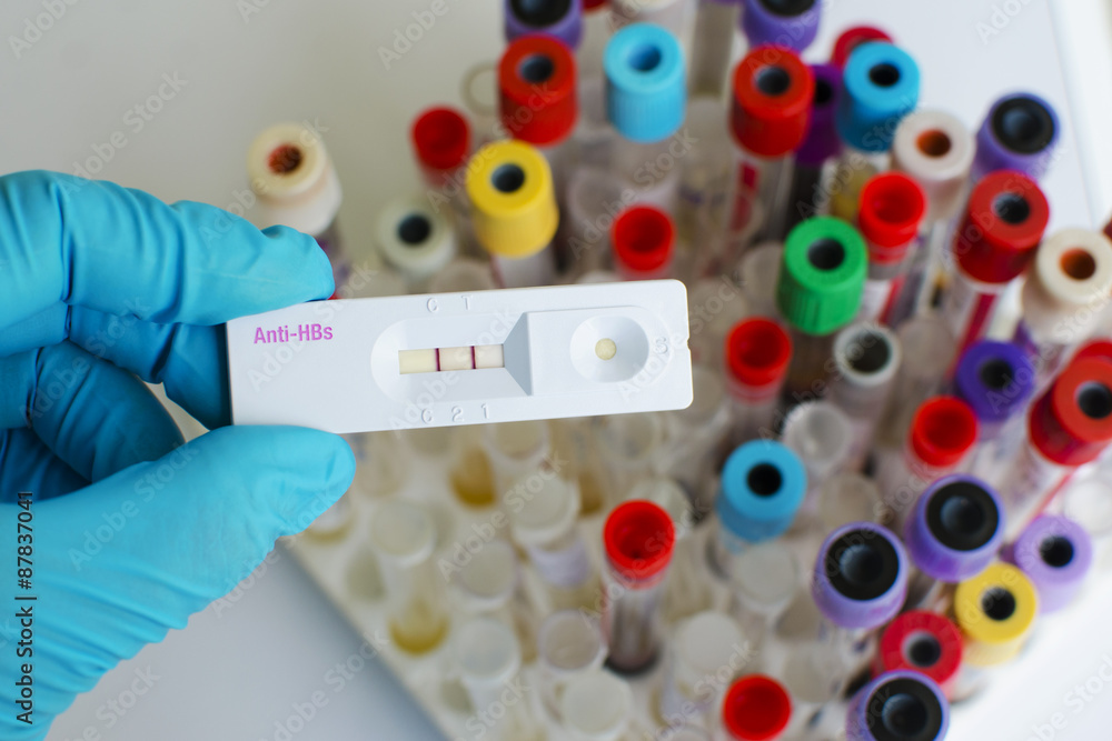 Fototapeta premium Anti-HBs (Hepatitis B antibody) positive