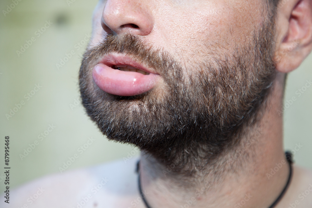 Swollen lip Swollen lip