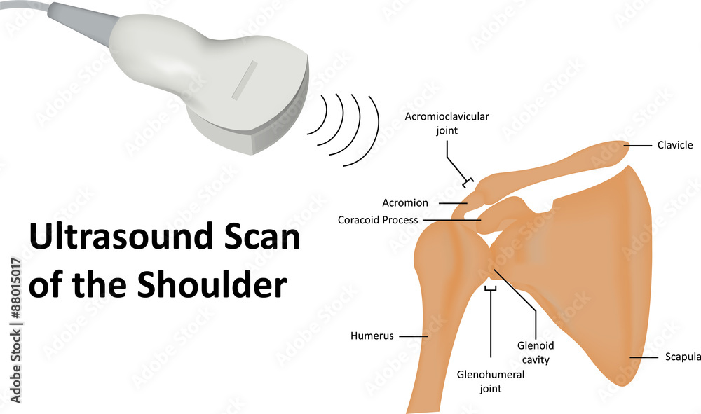 Ultrasound Scan of Shoulder Ultrasound Scan of Shoulder