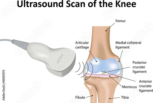 Ultrasound Scan of Knee